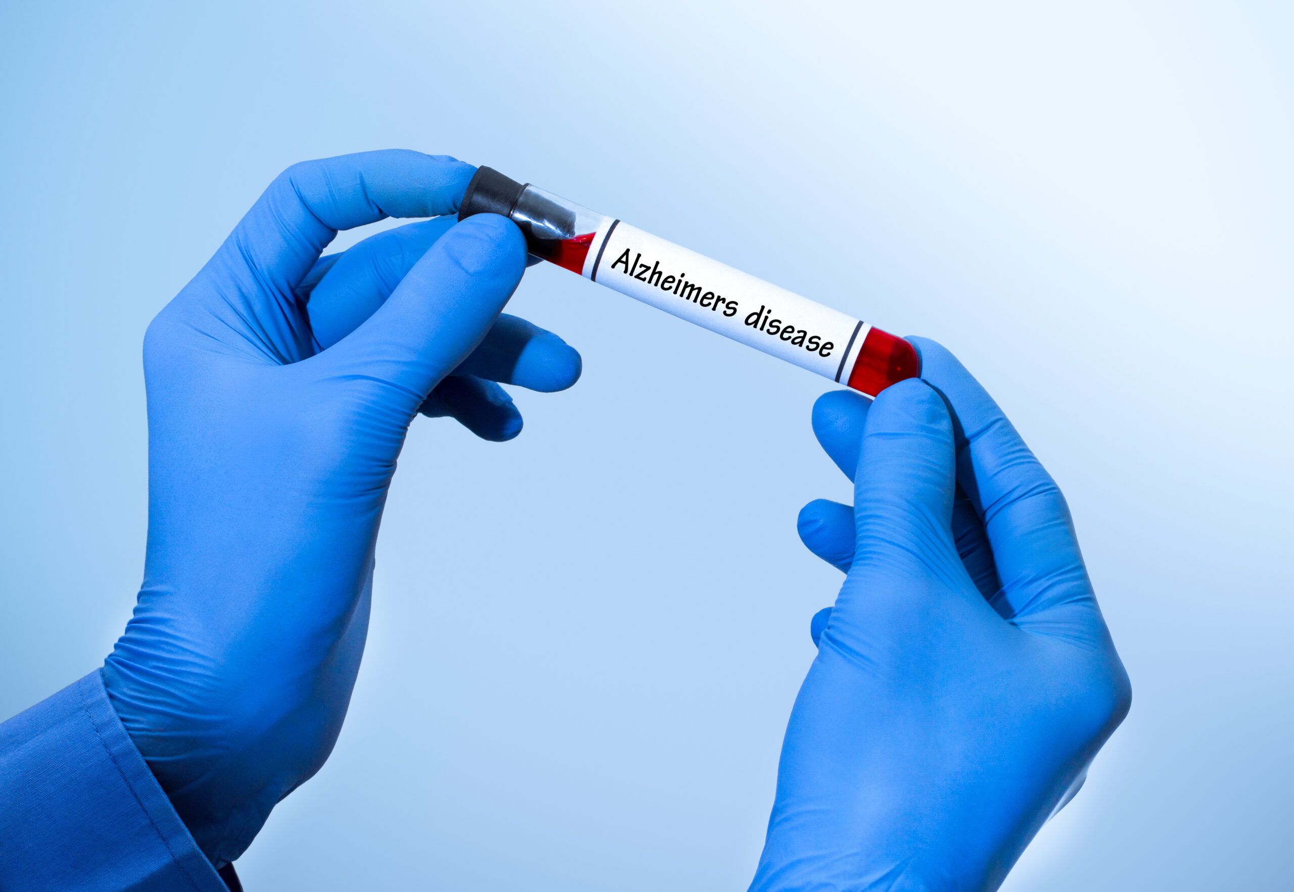 alzheimers disease test - Buffalo Healthy Living Magazine