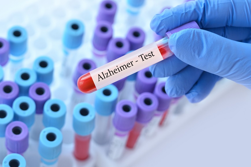 An FDA-Approved Blood Test for Alzheimer’s Disease