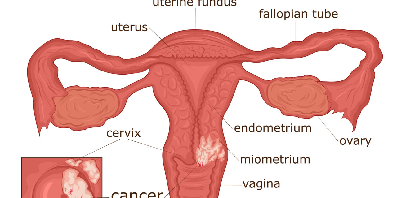 Can You Get Cervical Cancer After a Hysterectomy?