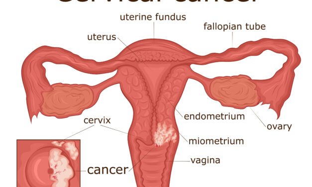 Can You Get Cervical Cancer After a Hysterectomy?