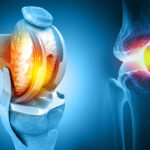 Common Questions About Hip and Knee Replacement