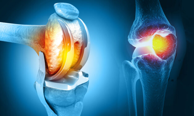 Common Questions About Hip and Knee Replacement