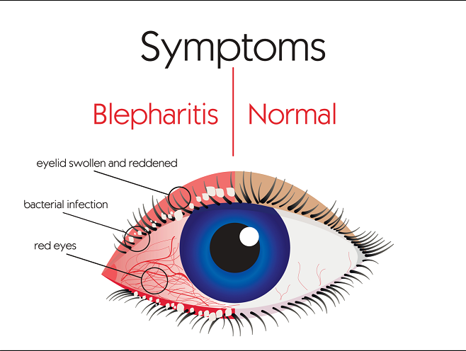 Dry Eye: A Common, Chronic Condition. What Really Helps 