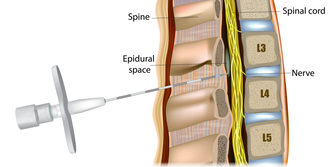 Fluoroscopic Guided Steroid Injections Help Relieve Pain