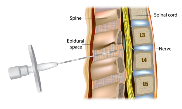 Fluoroscopic Guided Steroid Injections Help Relieve Pain