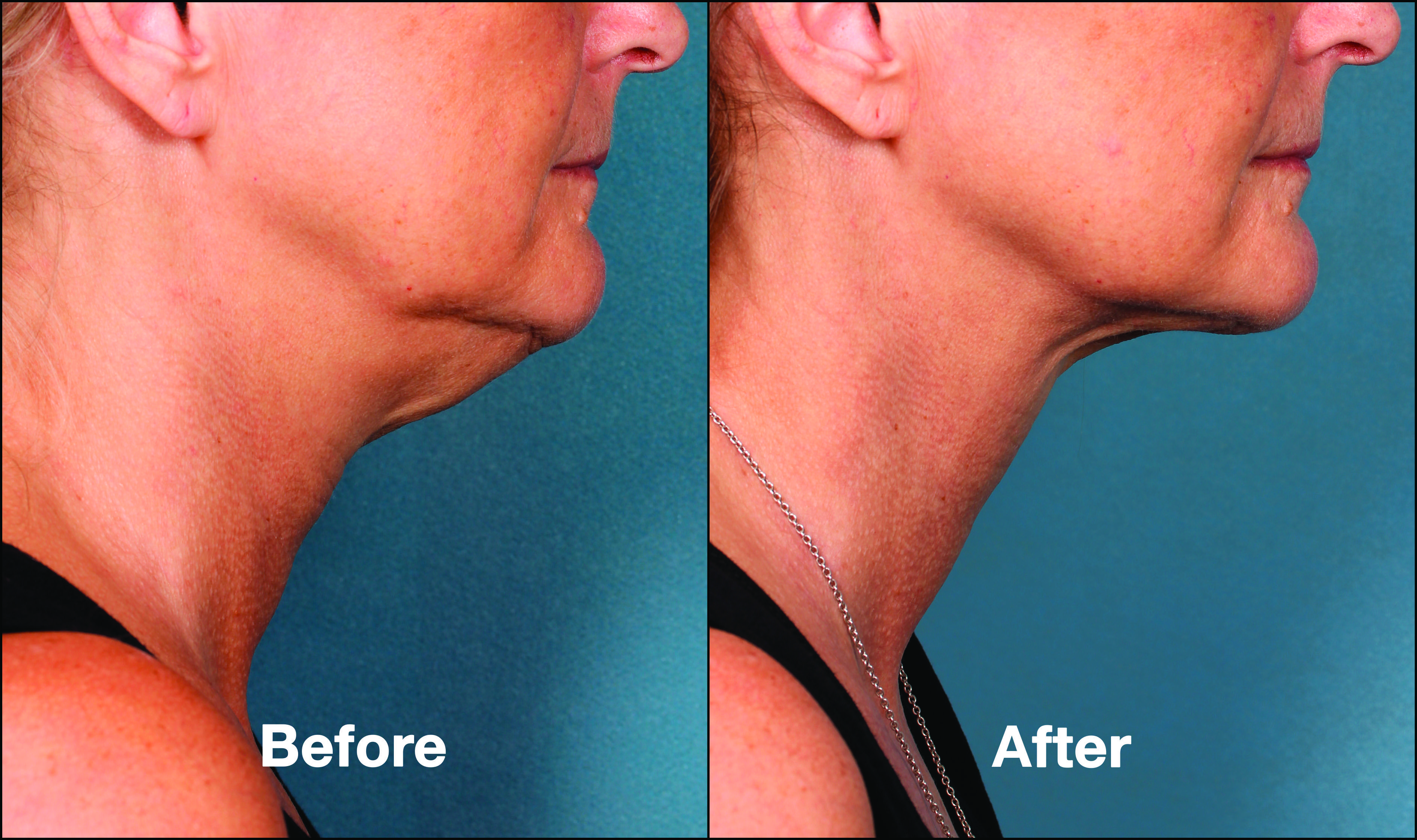 Get Rid of Your Double Chin!