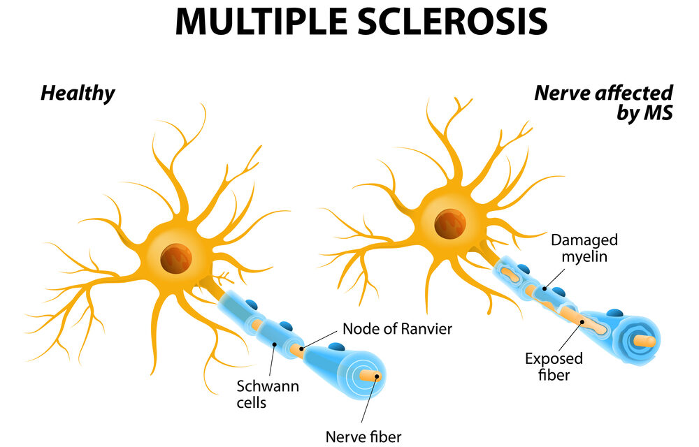 Medical 411: Multiple Sclerosis