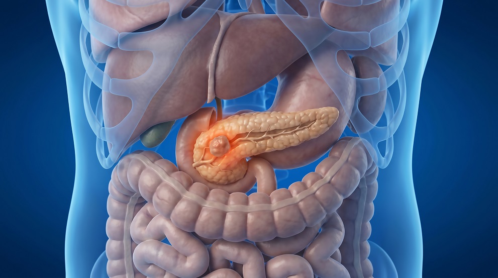 New Hope in the Fight Against Pancreatic Cancer 