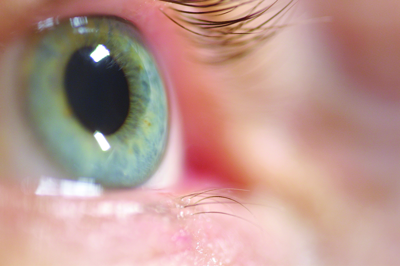 Open Your Eyes to the Threat of Glaucoma - Buffalo Healthy Living