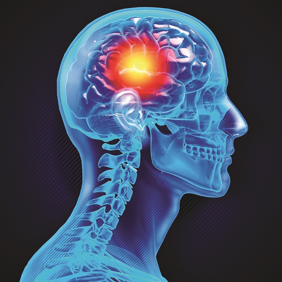 Risk Factors for Stroke: Including Those You Can Control  