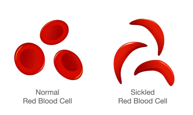 Sickle Cell Anemia: September is Sickle Cell Awareness Month