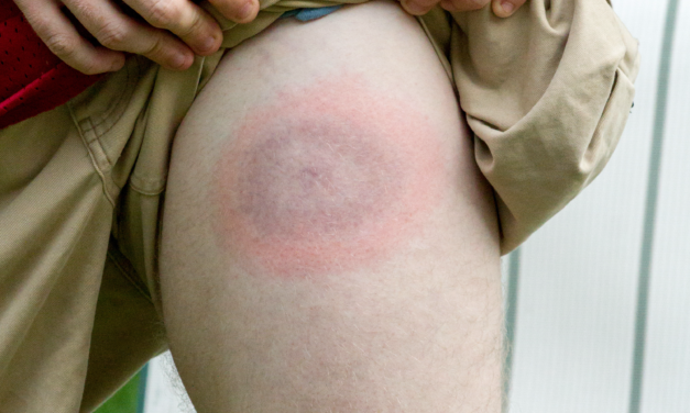 Signs and Symptoms of Lyme Disease 