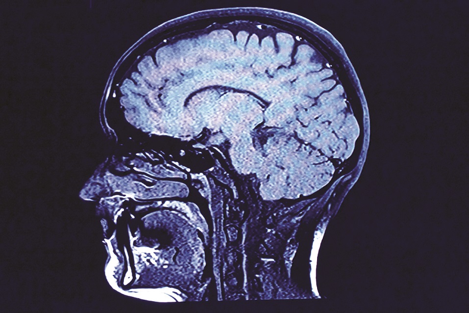 Signs of Minor Brain Injuries  