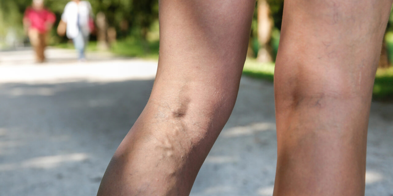 Varicose Vein Treatment Options at Windsong