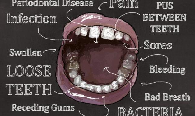 What is Periodontal Disease?