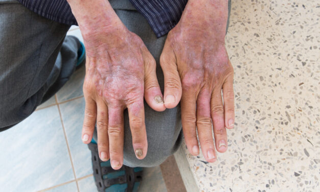 What is Scleroderma?