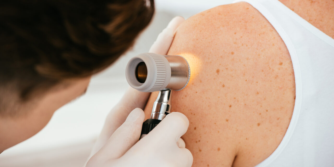 What to Look for if You’re Concerned About Melanoma