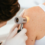 What to Look for if You’re Concerned About Melanoma