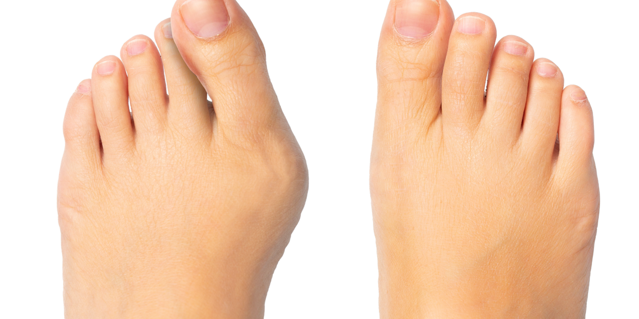 Lapiplasty: A State-of-the-Art Procedure for Bunion Removal!