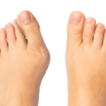 Lapiplasty: A State-of-the-Art Procedure for Bunion Removal!